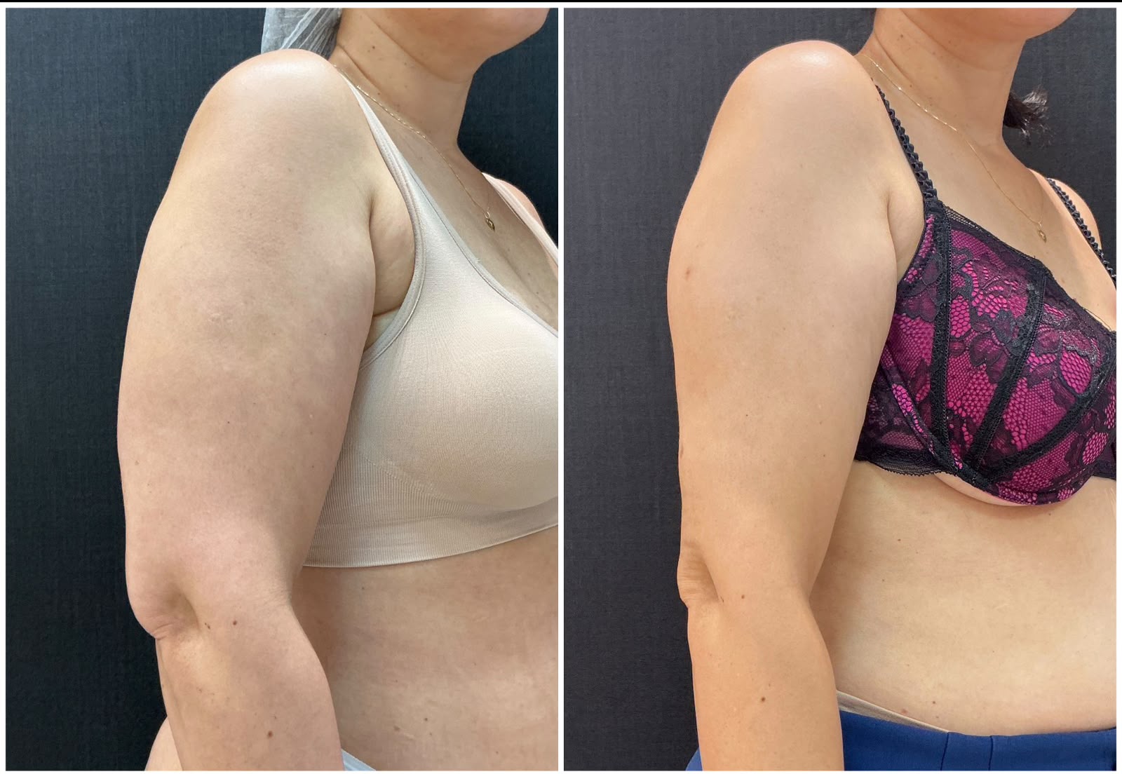 Antes e depois do protocolo — braço