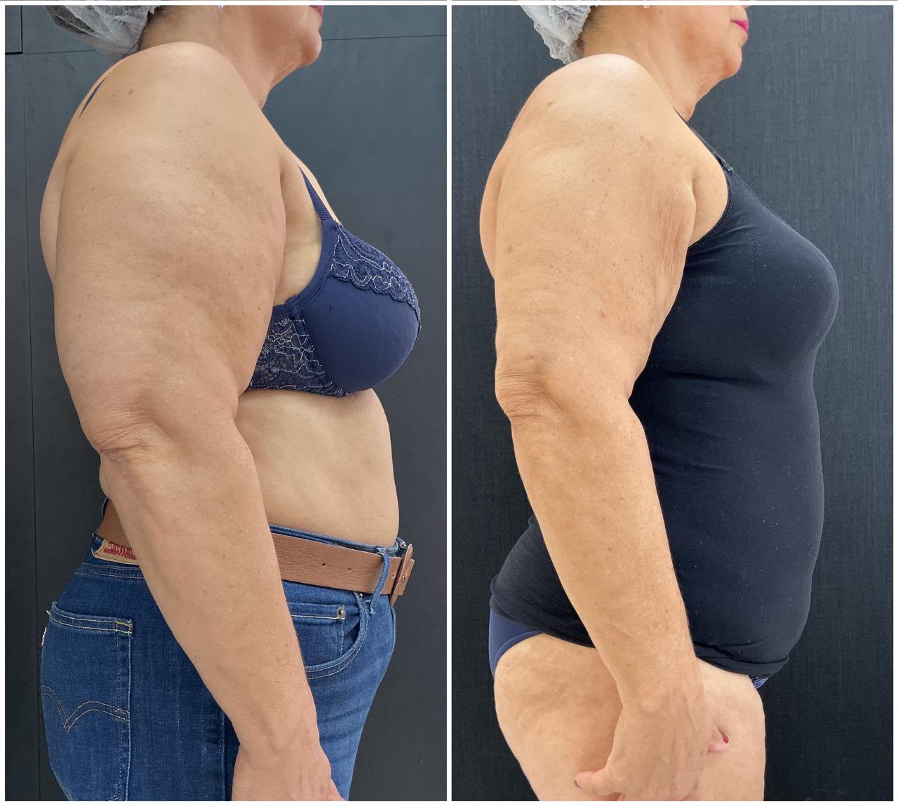 Antes e depois do protocolo — braço
