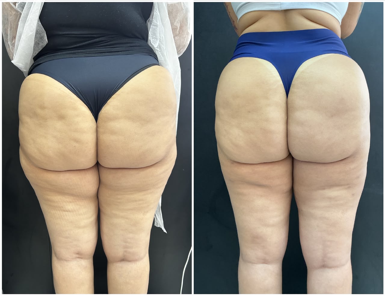 Antes e depois do protocolo — glúteos e posterior de coxa