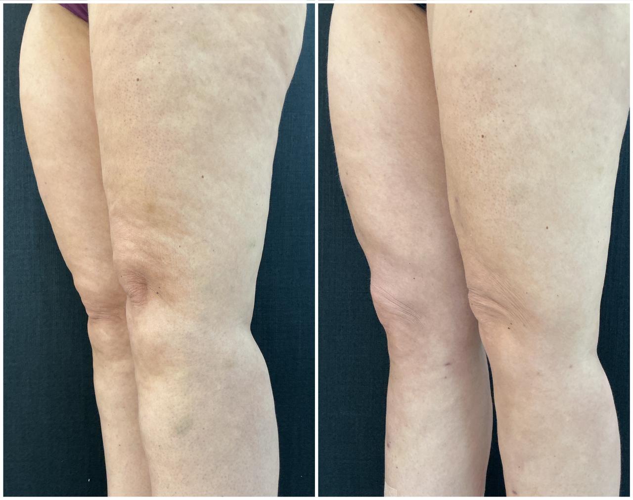 Antes e depois do protocolo — posterior de coxa e joelho