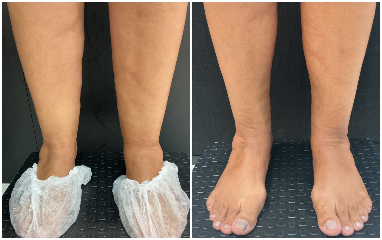 Antes e depois do protocolo — pernas e tornozelos